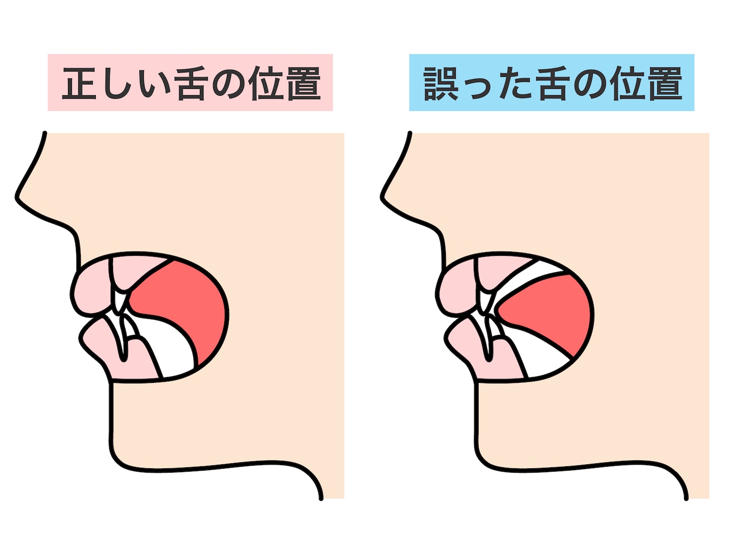 舌の正しいポジション