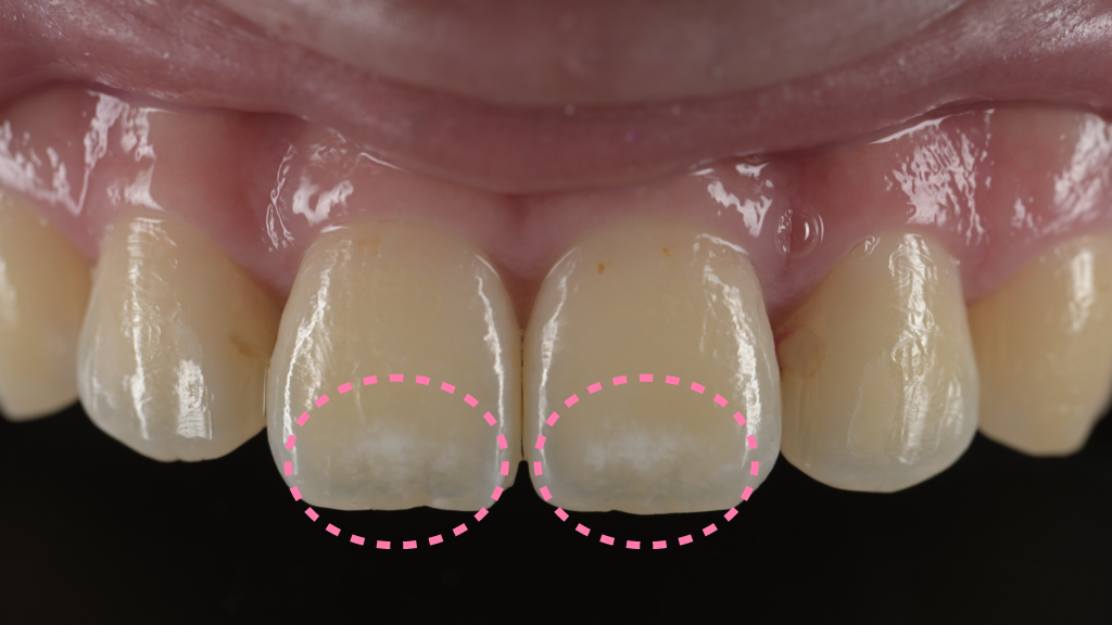ホワイトスポットとは？