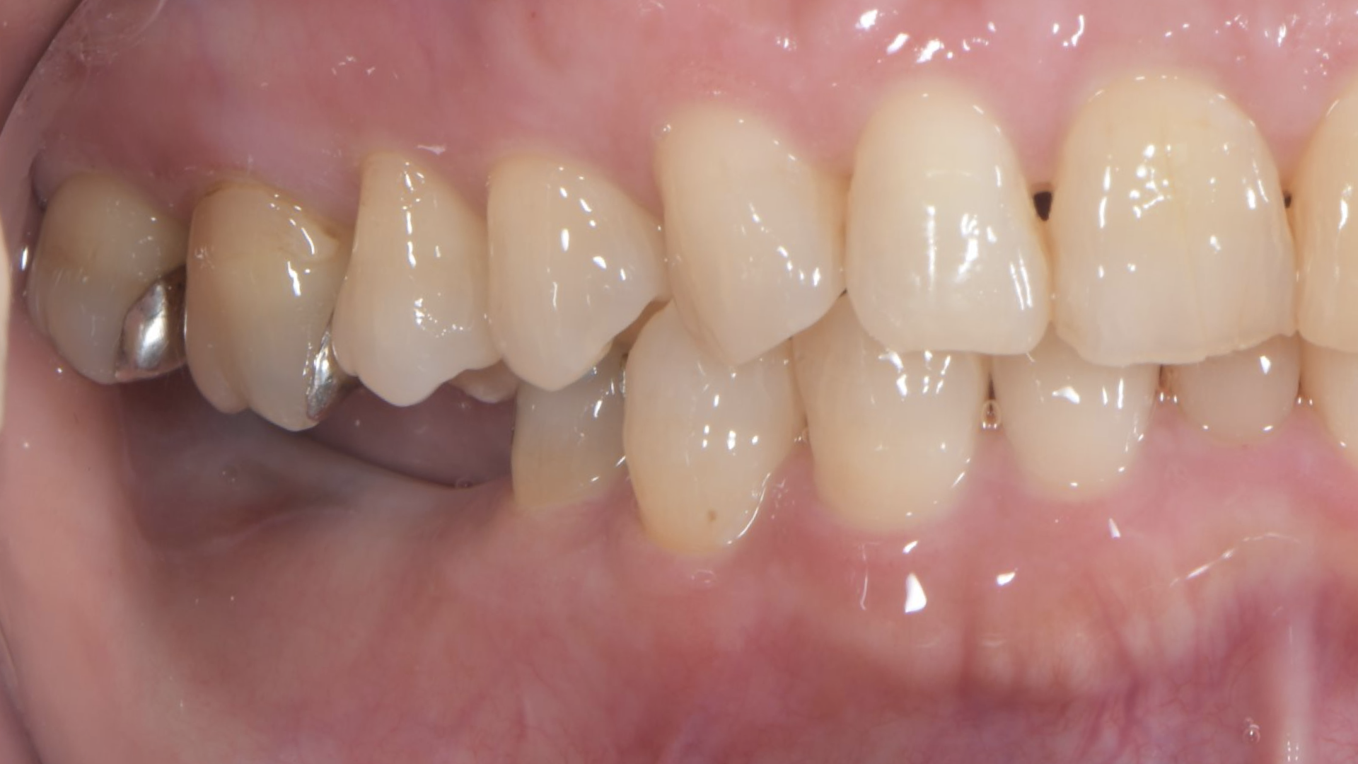 奥歯へのインプラント治療とセラミック治療 Before