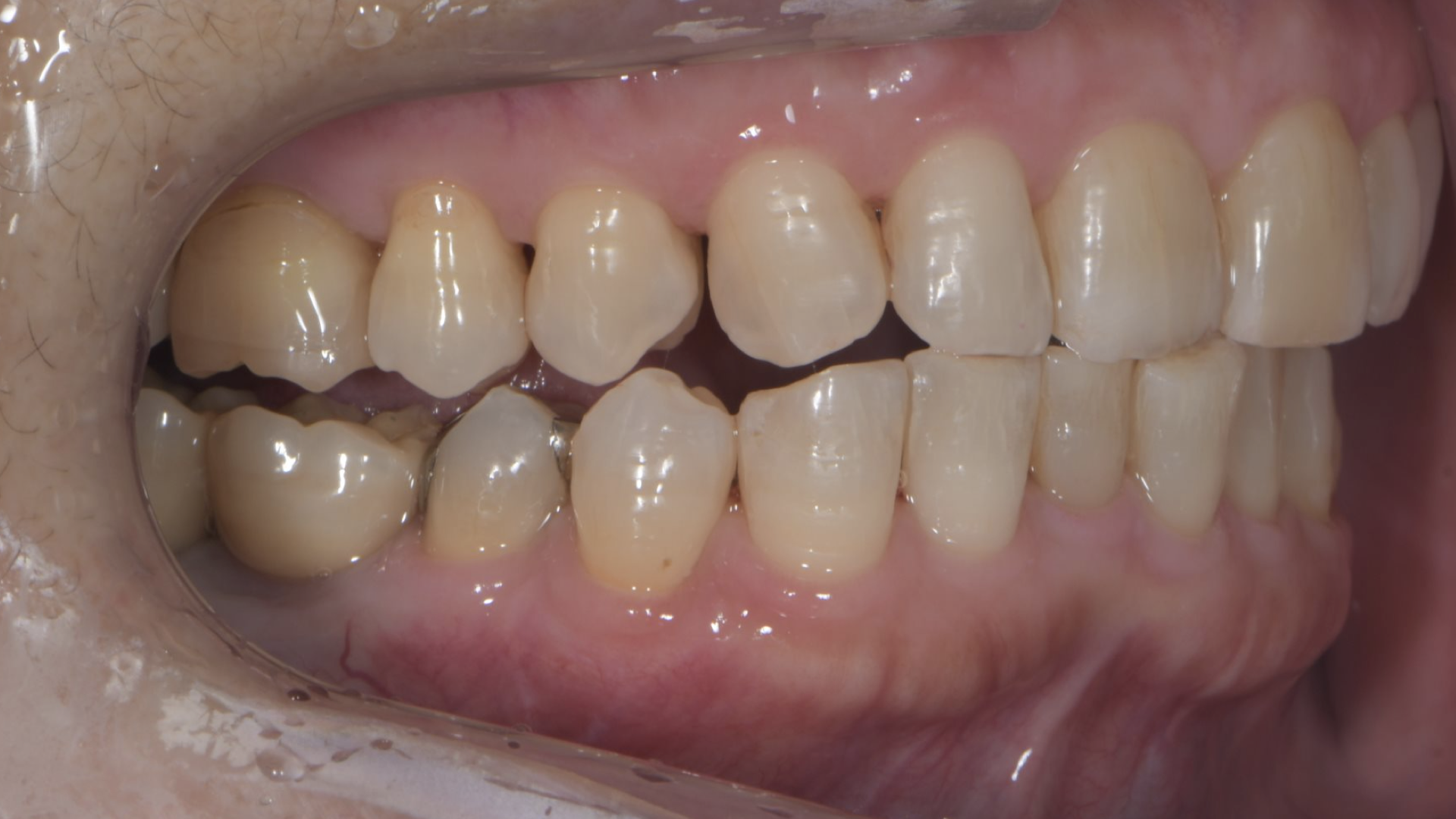 奥歯へのインプラント治療とセラミック治療 After